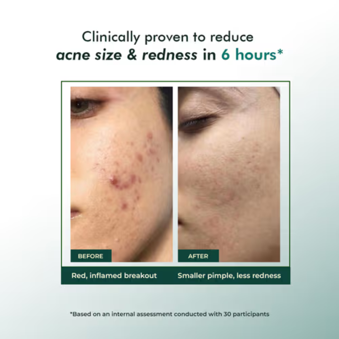 Conscious Chemist Acne Relief Gel | Reduces Pimples Fast | Controls Oil | Calms Redness