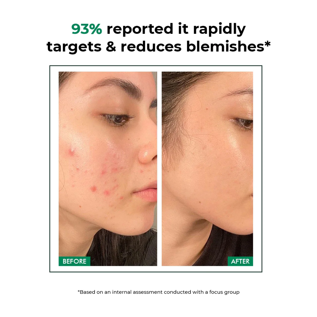 Conscious Chemist Acne Relief Gel | Reduces Pimples Fast | Controls Oil | Calms Redness