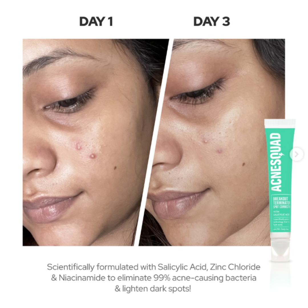 AcneSquad Acne Defense Spot Corrector | Clears Pimples, Kills Acne Bacteria & Fades Dark Spots