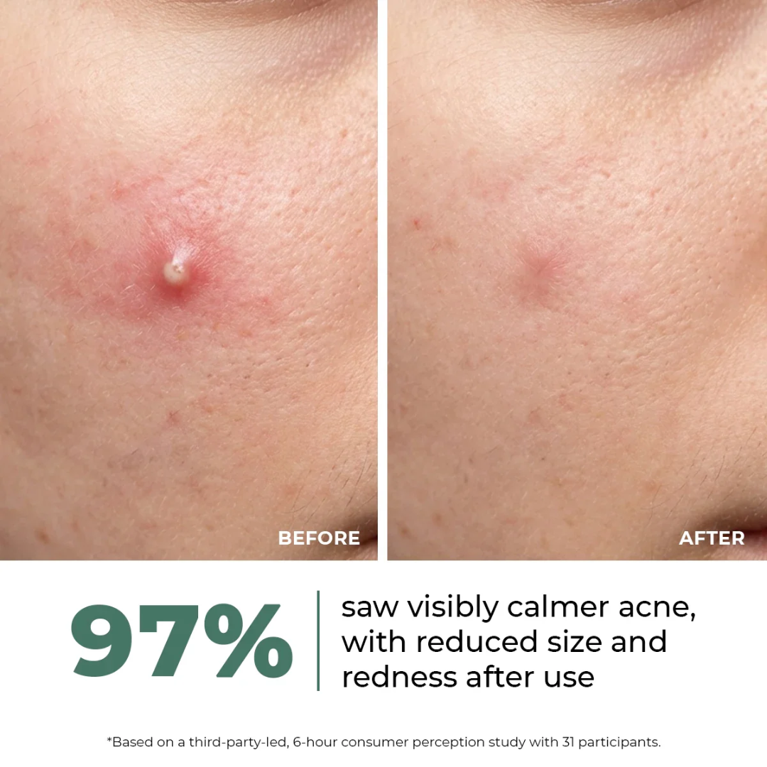 Conscious Chemist Acne Relief Gel | Reduces Pimples Fast | Controls Oil | Calms Redness