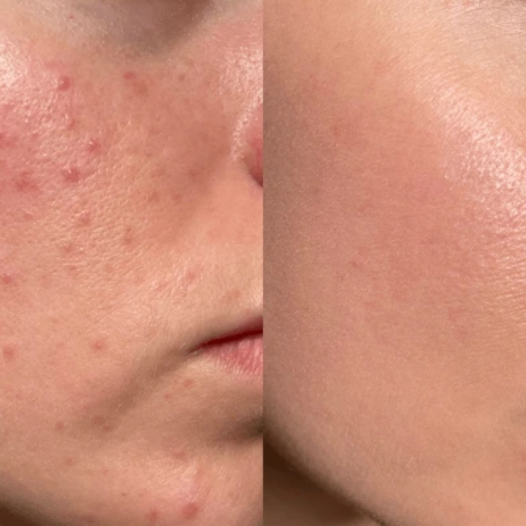 Conscious Chemist Acne Relief Gel | Reduces Pimples Fast | Controls Oil | Calms Redness