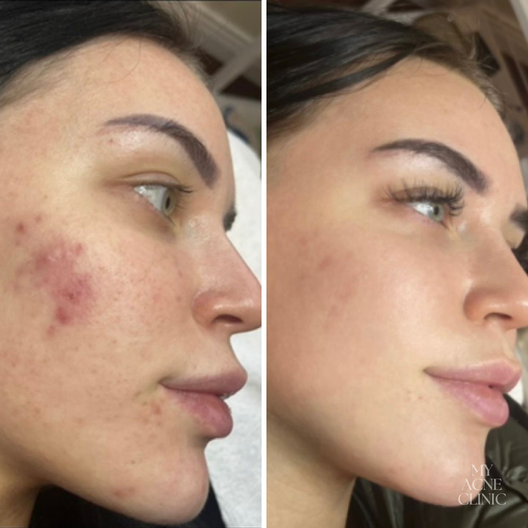 Conscious Chemist Acne Relief Gel | Reduces Pimples Fast | Controls Oil | Calms Redness