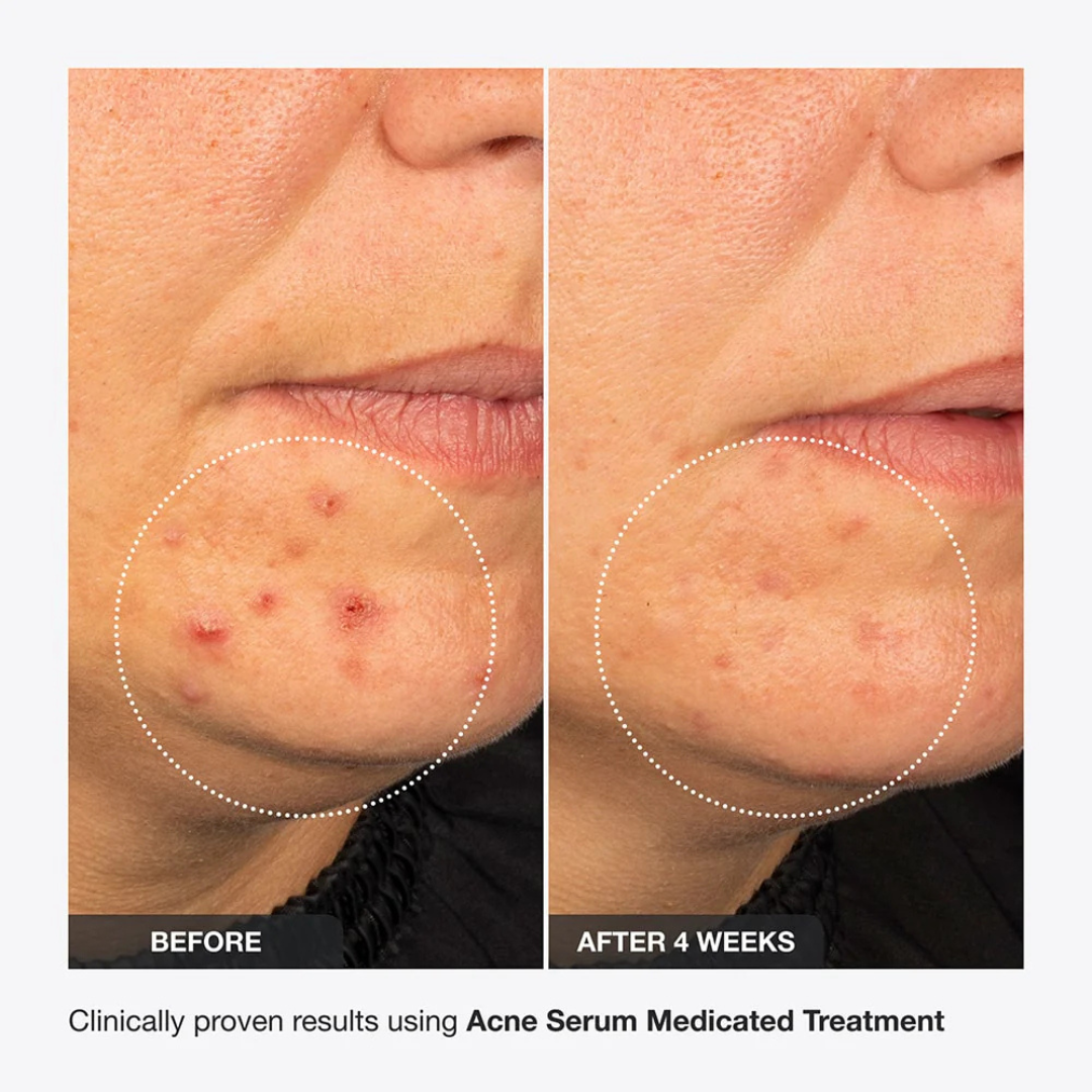 AcneSquad Acne Defense Spot Corrector | Clears Pimples, Kills Acne Bacteria & Fades Dark Spots