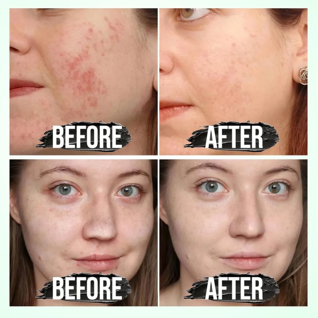 Suroskie peel off mask | cleanse & tighten pores | Glass like Skin in 20 minutes