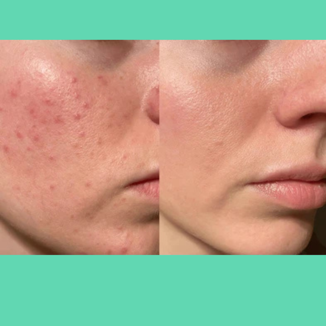 AcneSquad Acne Defense Spot Corrector | Clears Pimples, Kills Acne Bacteria & Fades Dark Spots