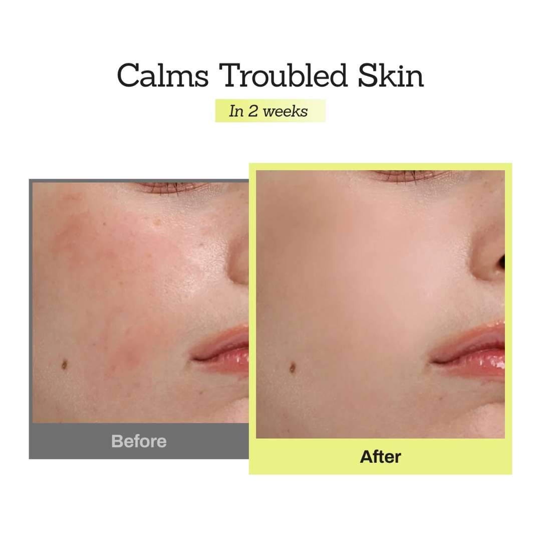 Orien Soothing Spray Toner for Spotless Skin - Removes Acne, Fades Dark Spots, Reveals Glow