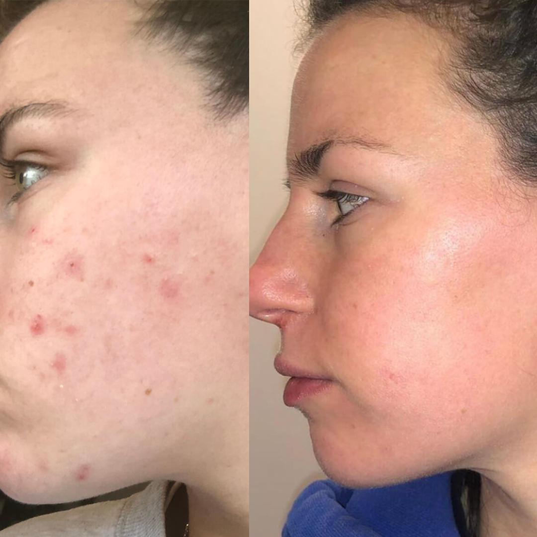 AcneSquad Acne Defense Spot Corrector | Clears Pimples, Kills Acne Bacteria & Fades Dark Spots