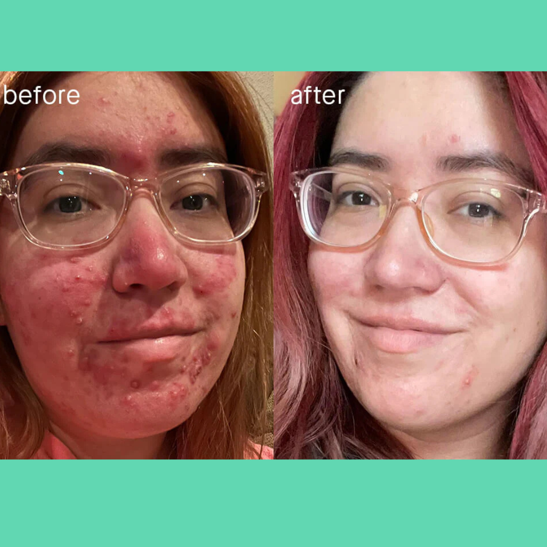 AcneSquad Acne Defense Spot Corrector | Clears Pimples, Kills Acne Bacteria & Fades Dark Spots