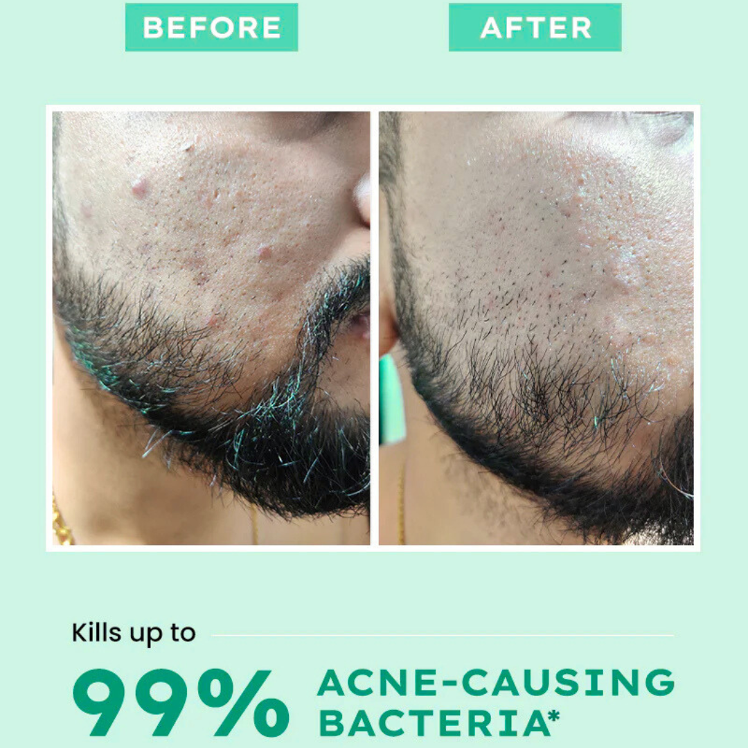 AcneSquad Acne Defense Spot Corrector | Clears Pimples, Kills Acne Bacteria & Fades Dark Spots