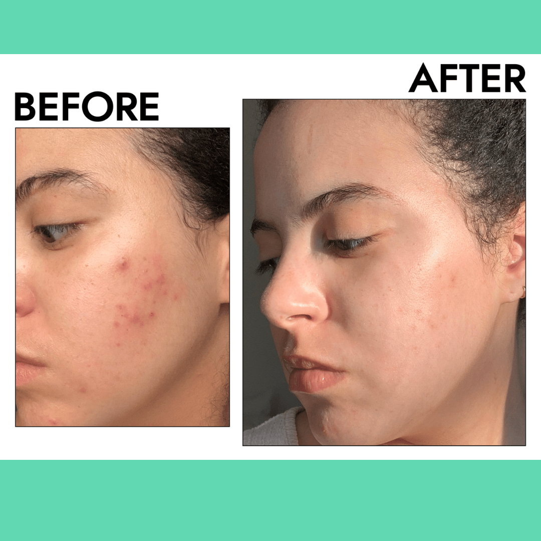 AcneSquad Acne Defense Spot Corrector | Clears Pimples, Kills Acne Bacteria & Fades Dark Spots