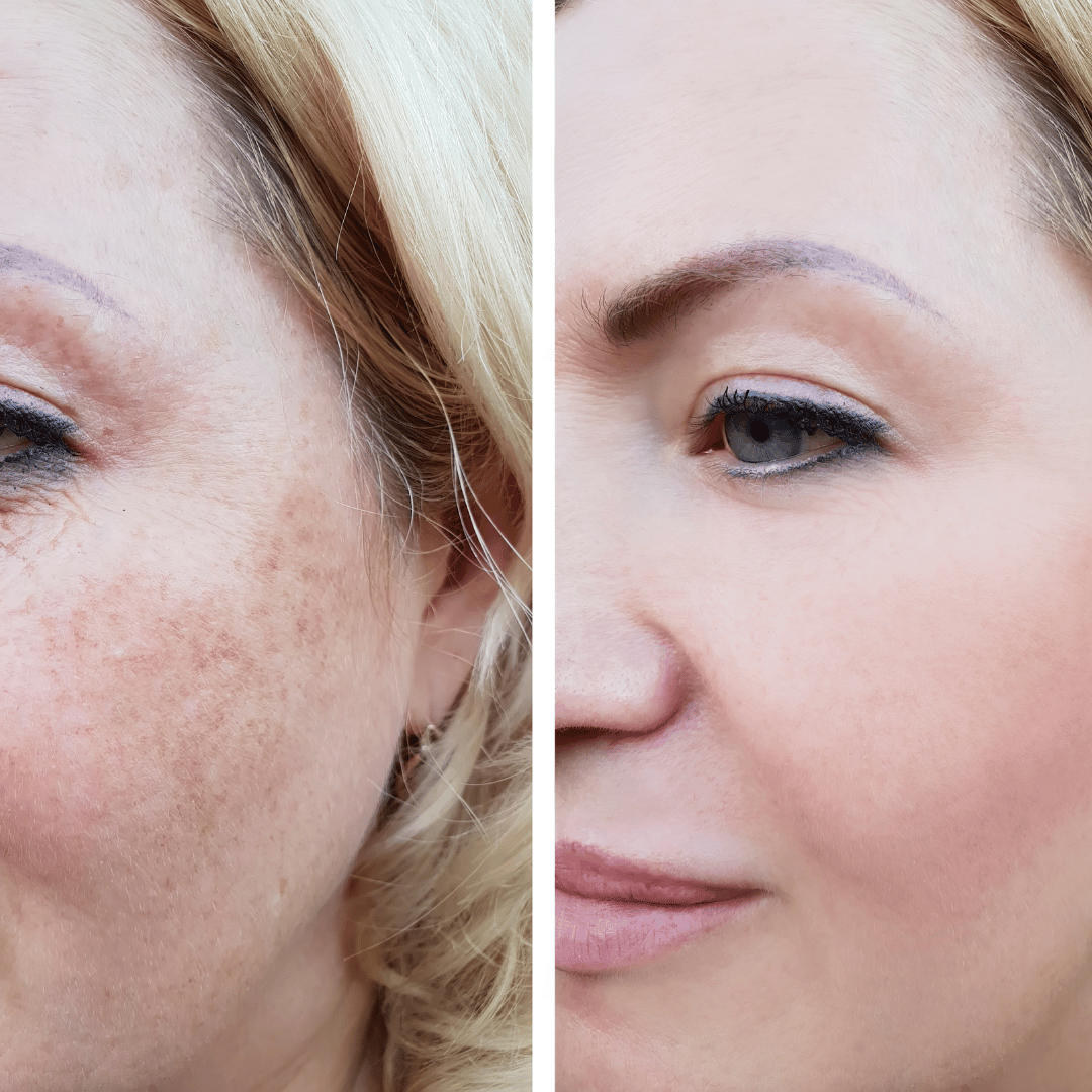 AcneSquad Acne Defense Spot Corrector | Clears Pimples, Kills Acne Bacteria & Fades Dark Spots