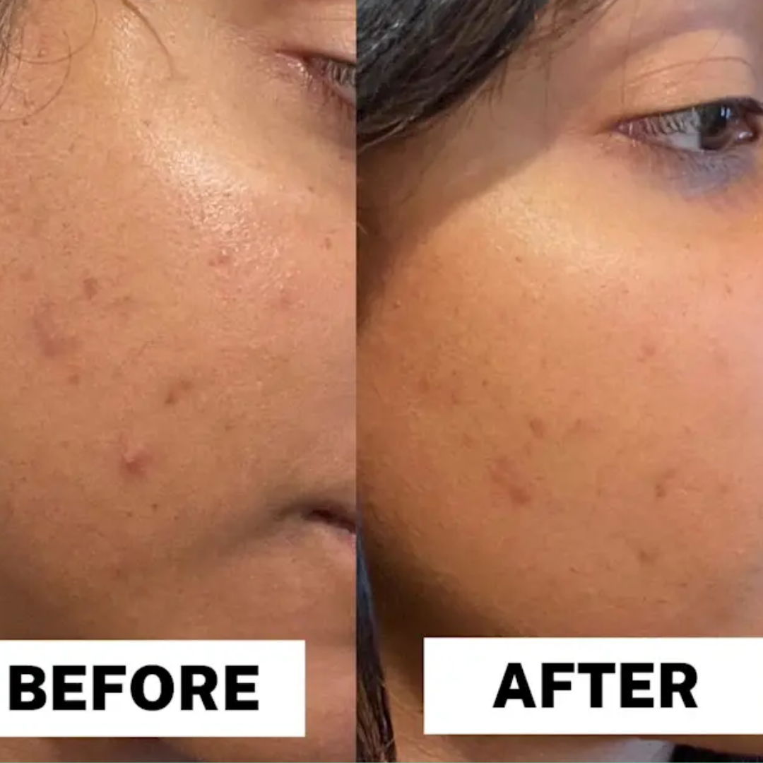 AcneSquad Acne Defense Spot Corrector | Clears Pimples, Kills Acne Bacteria & Fades Dark Spots