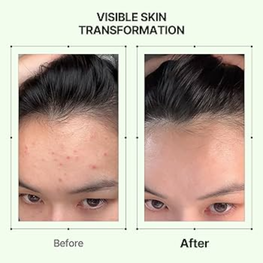 Orien Soothing Spray Toner for Spotless Skin - Removes Acne, Fades Dark Spots, Reveals Glow